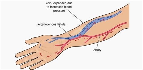 AV fistula