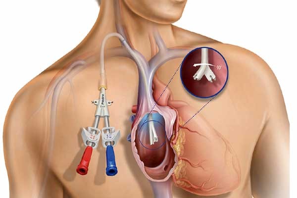 Tunnelled Dialysis Line
